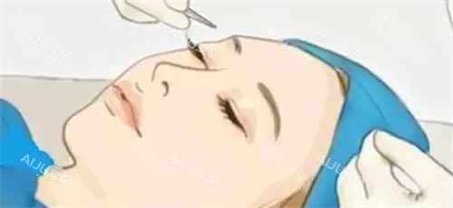 深圳曹思佳双眼皮手术过程卡通图