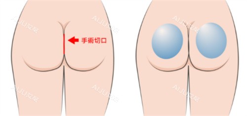 深圳康壮为假体丰臀手术切口