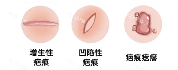 疤痕修复