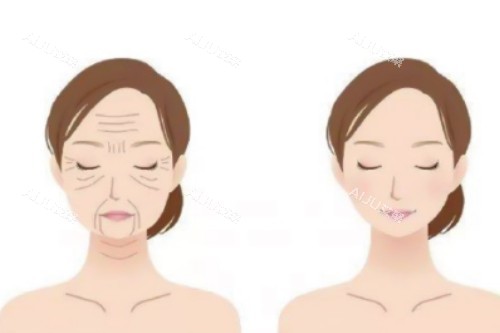 脸部抗衰前后对比图