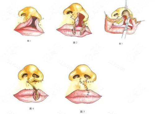 广州肖强唇腭裂修复过程简易卡通示意图