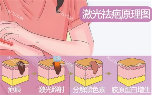 激光祛疤原理示图