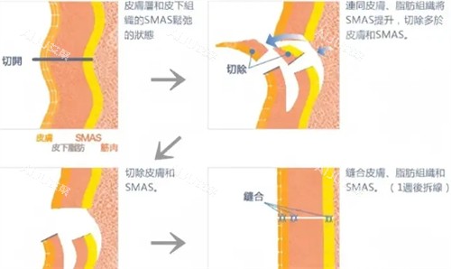 广州聂云飞拉皮手术过程