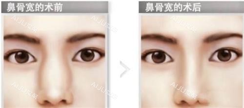 鼻骨内推前后的对比