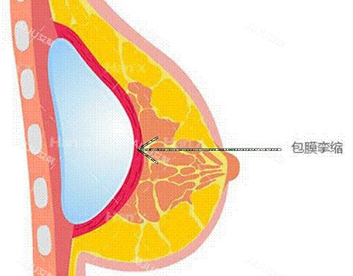 广州郭震宇假体丰胸薄膜挛缩示意图