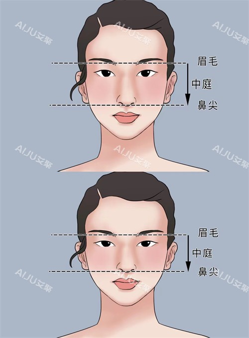 正常鼻子和过长鼻子矫正对比
