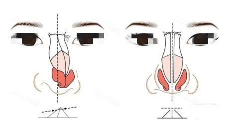 广州罗延平医生做鼻子到底妙在哪？手法精细塑形佳，术后自然还无惧揉捏