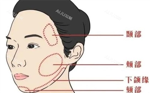 面部提升可以提升的区域