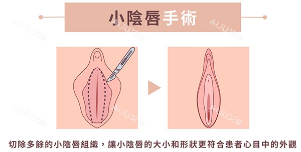 小阴唇整形手术前后照片