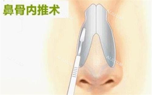 鼻骨内推手术示意图