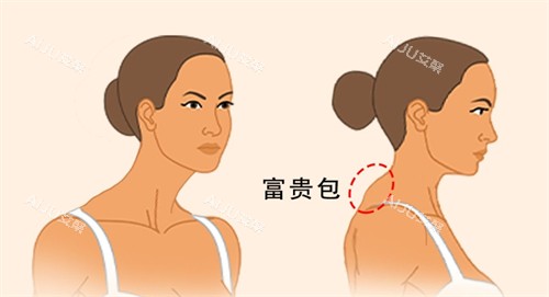 成都车红昌富贵包消除前后对比