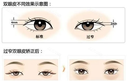 武汉龚卫华不同高度的双眼皮