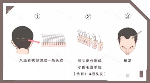 头发移植图示