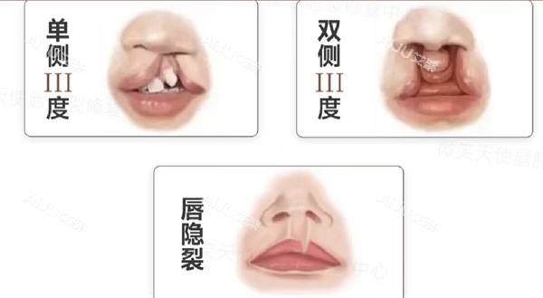 福州朱刚强医生唇裂分型