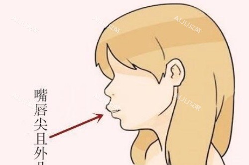 上唇外翻侧面形状示意图 上唇外翻侧面形状示意图
