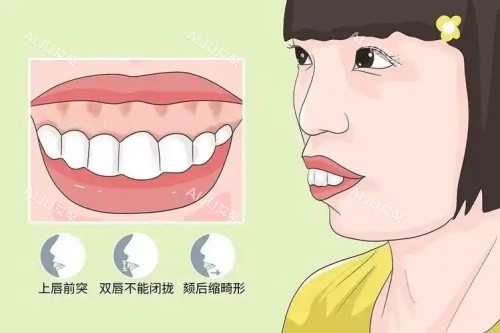 上唇外翻形态示意图