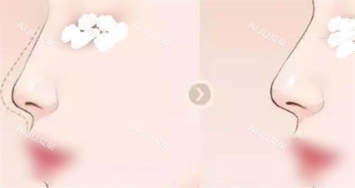 隆鼻鼻部鼻梁术前术后展示图