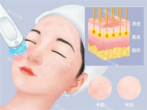 想改善肤质、除皱美白？微针治疗了解下，结果好费用1000 - 3000元左右