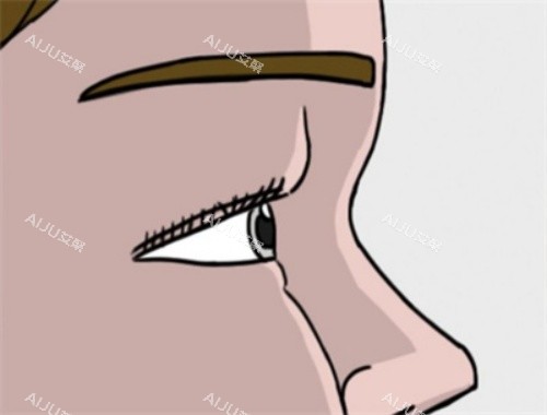 天生肿眼泡太苦恼？吸脂、双眼皮手术等方法帮你改善，结果看得见