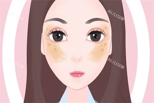 黄褐斑图片一览