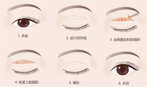 提眉手术步骤分解