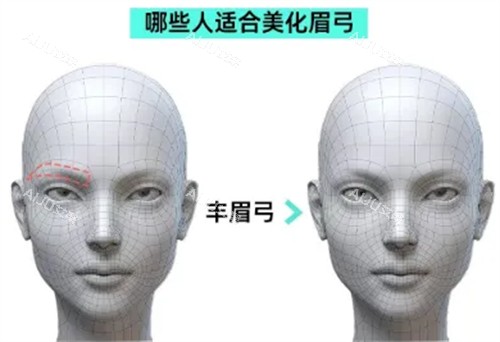 哪些人适合做眉弓整形