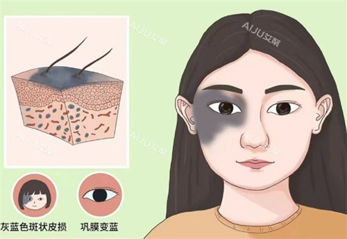 太田痣的样子