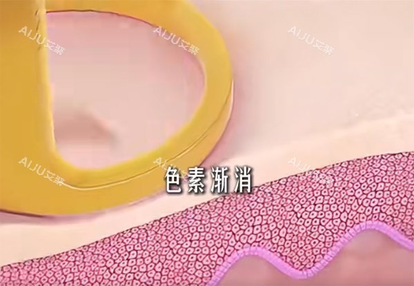 调Q激光改善黑色素