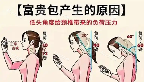 富贵包产生的原因.webp