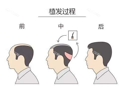 植发过程图示
