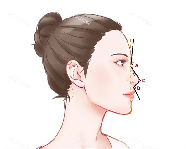 鼻尖塑形