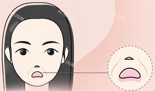 法令纹