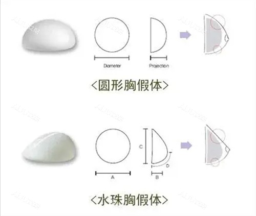 丰胸手术曼托圆形及水滴形假体植入示意图