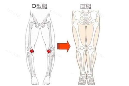 腿型矫正图对比