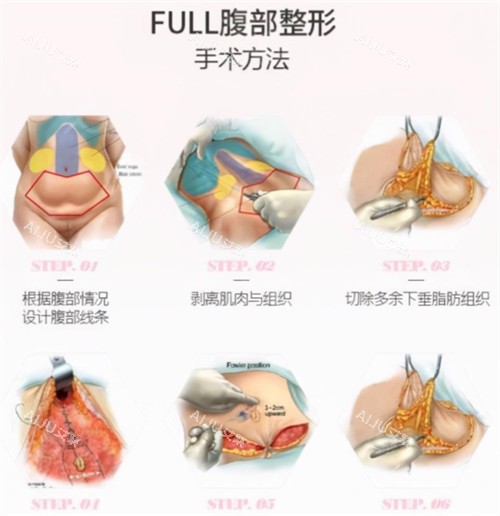 腹壁成形术手术过程图解