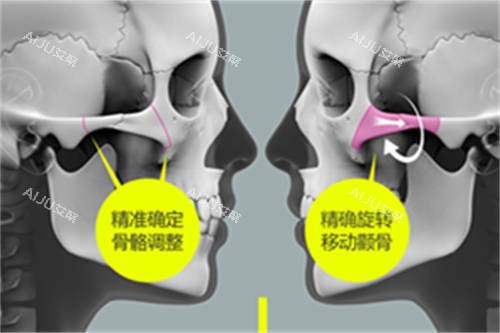 北京圣嘉新医疗美容医院张笑天颧骨颧弓整形示意图