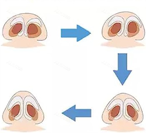 歪鼻