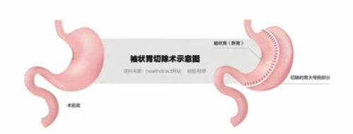 袖状胃切除手术示意图