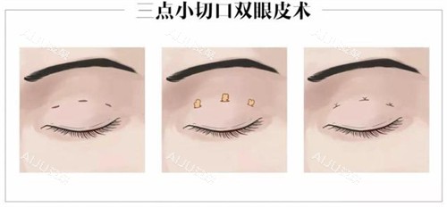 深圳朱武根三点定位双眼皮的操作步骤