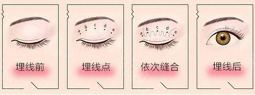 深圳朱武根埋线双眼皮过程示意图片