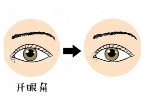 开眼角对比图