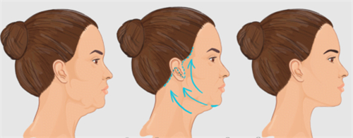 深圳刘富增面部提升改善皮肤状态 深圳刘富增面部提升改善皮肤状态