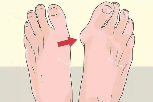 苏敬达医生大脚骨整形前后对比图 苏敬达医生大脚骨整形前后对比图