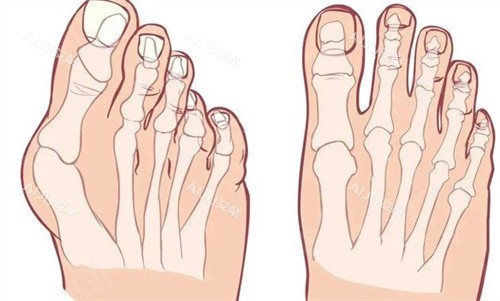 苏敬达医生大脚骨的脚和正常对比 苏敬达医生大脚骨的脚和正常对比