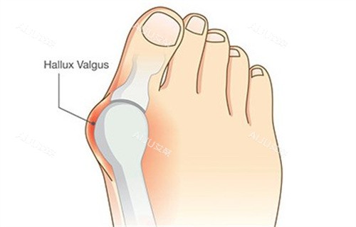 苏敬达医生大脚骨解析 苏敬达医生大脚骨解析