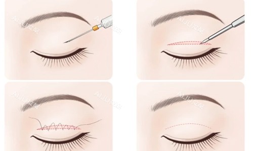 常冬青医生全切双眼皮简易术后流程