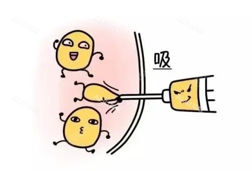 抽脂漫画示意图 抽脂漫画示意图