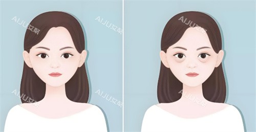 祛眼袋手术前后对比