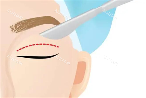 割双眼皮示意图 割双眼皮示意图