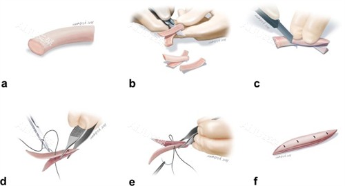 赣州华美雕刻鼻整形填充物